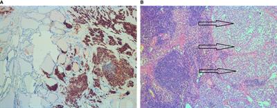 Case Report: Medullary Thyroid Cancer Workup Initiated by Unexpectedly High Procalcitonin Level—Endocrine Training Saves Life in the COVID-19 Unit